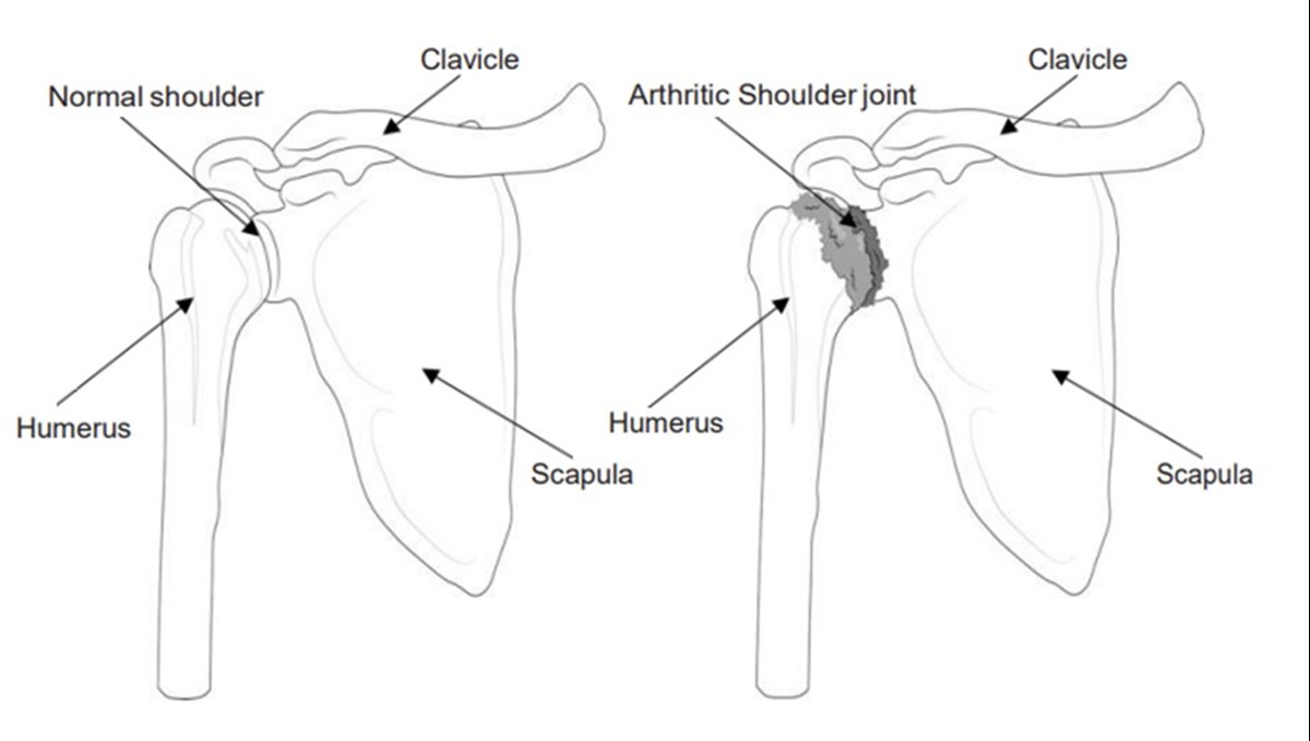 Shoulder Bones Showing Arthritic Joint